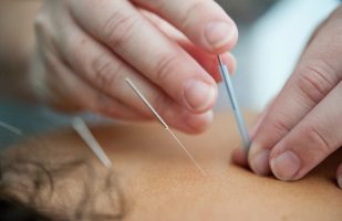 acupuncture_1 acupuncture on back